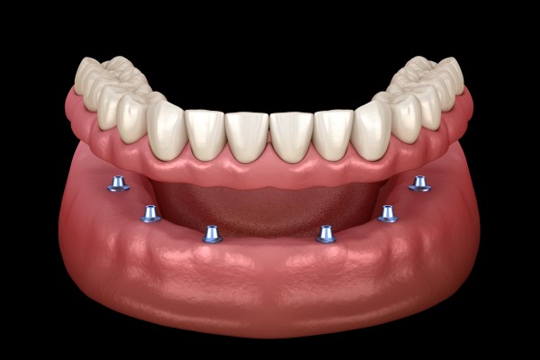 Dental Implants Replace All Teeth