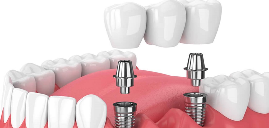 dental implants replace multiple teeth